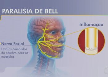 Paralisia de Bell: jornalista relata susto e desafios da recuperação de doença que 'congela' parte do rosto