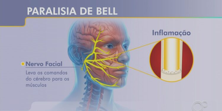 Paralisia de Bell: jornalista relata susto e desafios da recuperação de doença que 'congela' parte do rosto